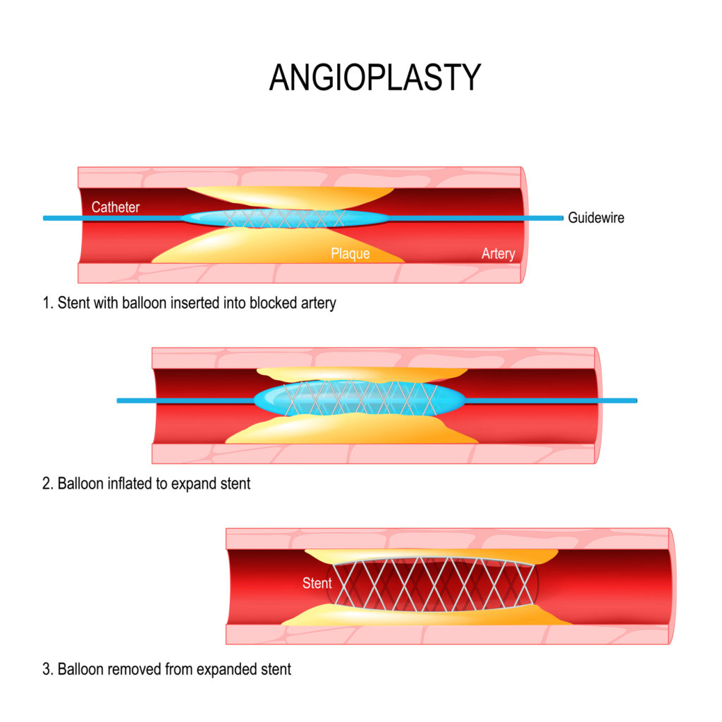 Balloon catheter and stent insertion