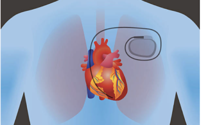 Permanent pacemakers: Why they’re needed and what to expect during surgery